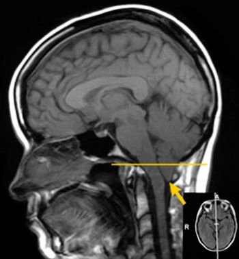 Chiropractic Lindon UT Chiari Malformation